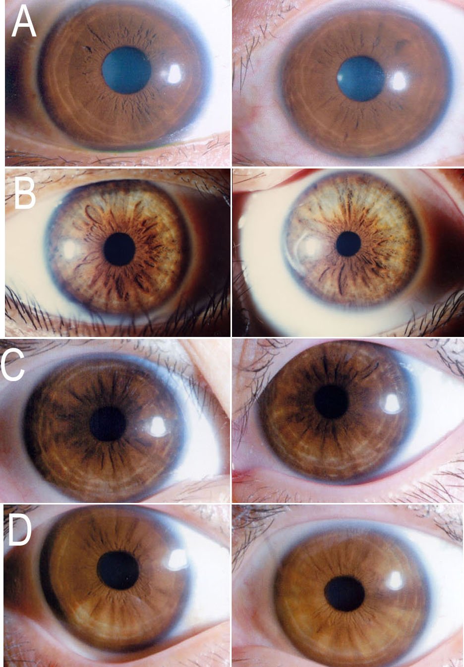Iridologie : Comprendre les Fondements de l'Observation de l'Iris 13 Comparaison de différents types d'iris montrant les variations de couleur et de structure