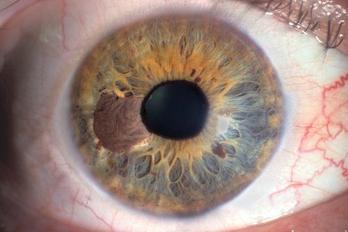 Tache Marron dans l'Iris de l'Oeil Signification 5 tache marron dans l'iris de l'oeil signification vue en gros plan sur iris bleu