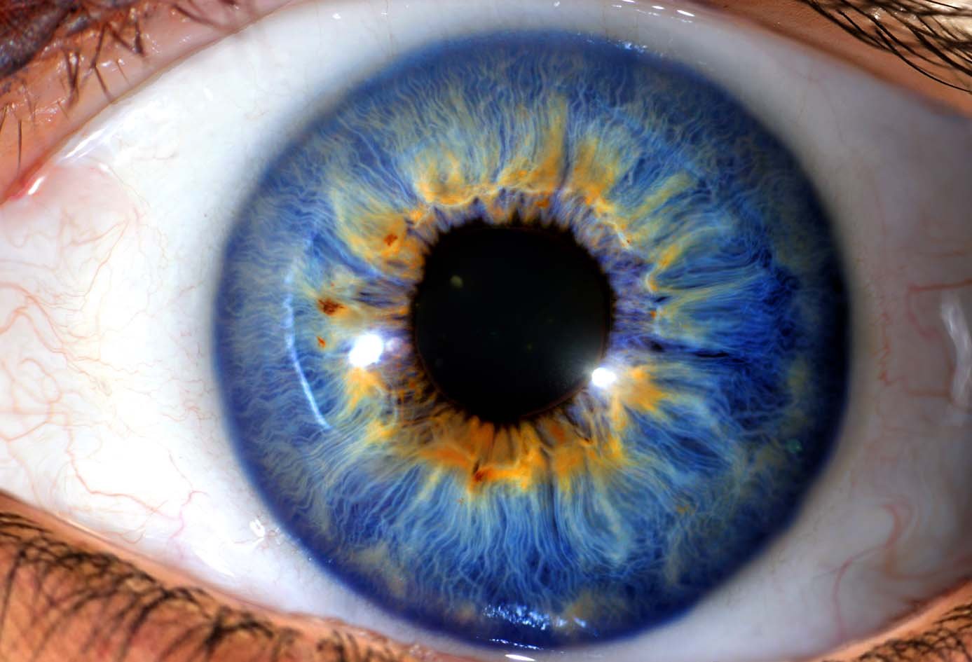 Gros plan sur des anneaux de stress nerveux dans l'iris