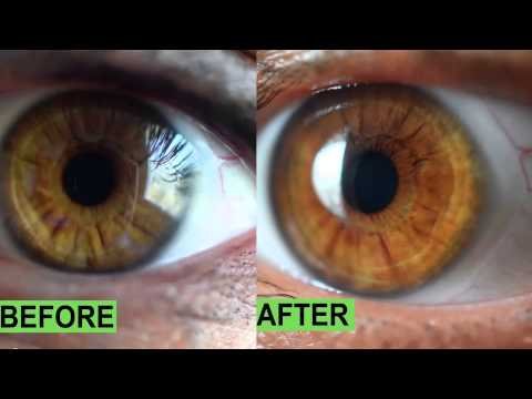 Comparaison entre analyse avec et sans iriscope professionnel