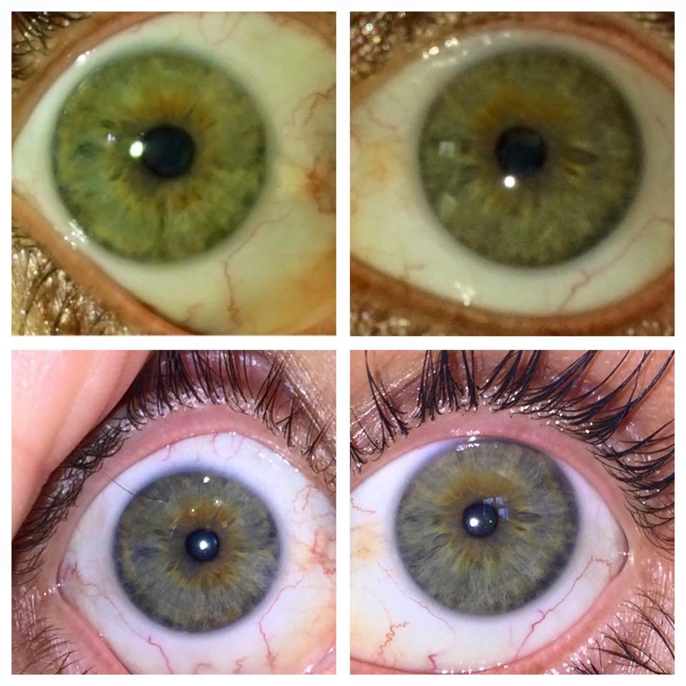 Comparaison entre analyse avec et sans iriscope professionnel