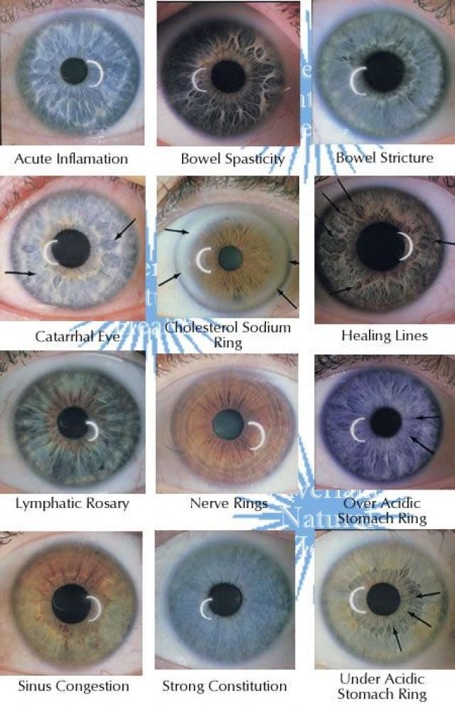 Chemical spots iridology e: Comprendre les Chemical Spots Iridology E avec Précision 6 Comparaison entre analyse avec et sans iriscope professionnel