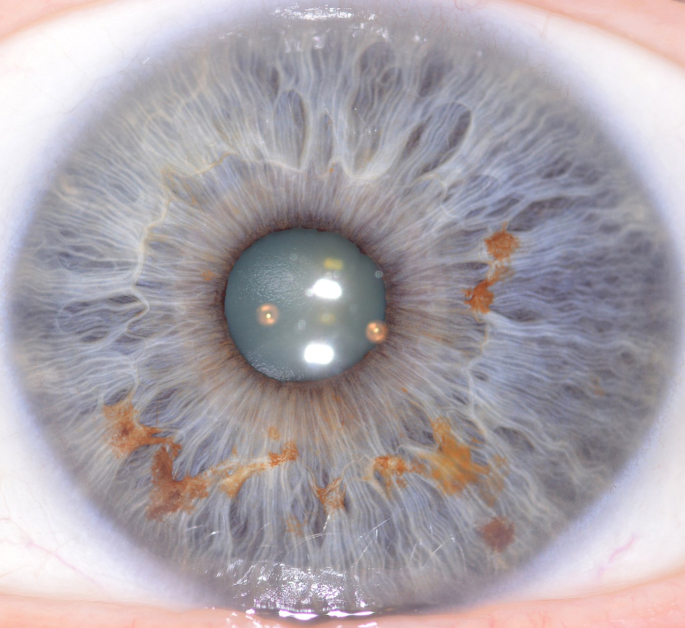 Iris Oeil Vert 4 Taches Iris