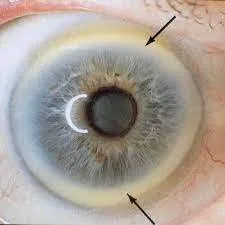 Iridoscope pour naturopathe: quel appareil choisir et comment l’intégrer à votre pratique en France — Iridology Iris sodium ring (2).jpg