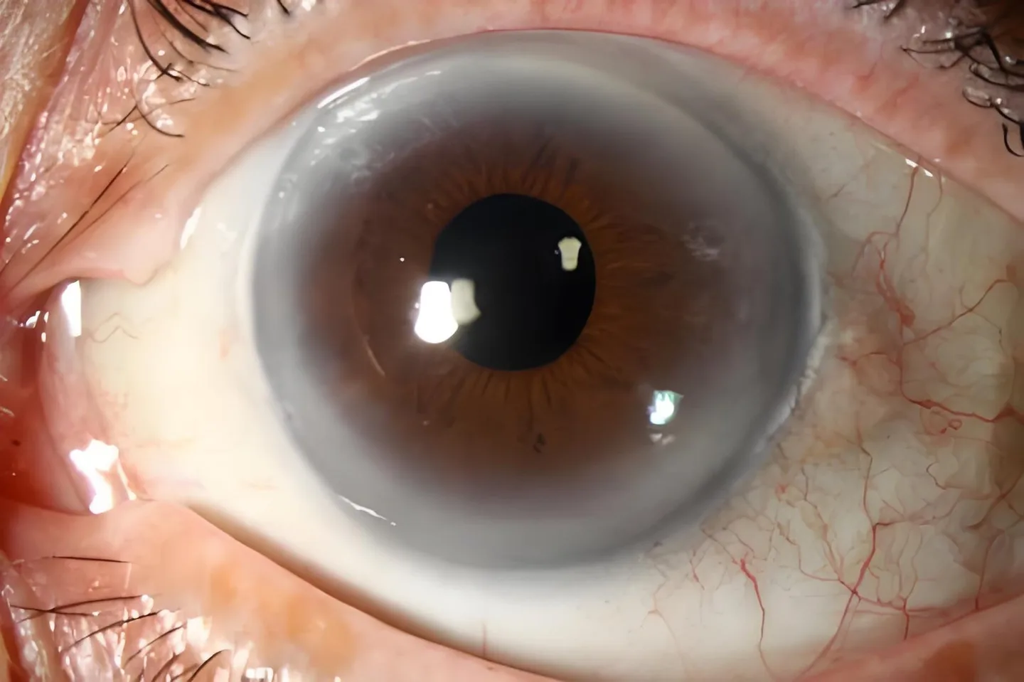 Iridoscope pour naturopathe: quel appareil choisir et comment l’intégrer à votre pratique en France — Iridology Iris sodium ring (4).jpg