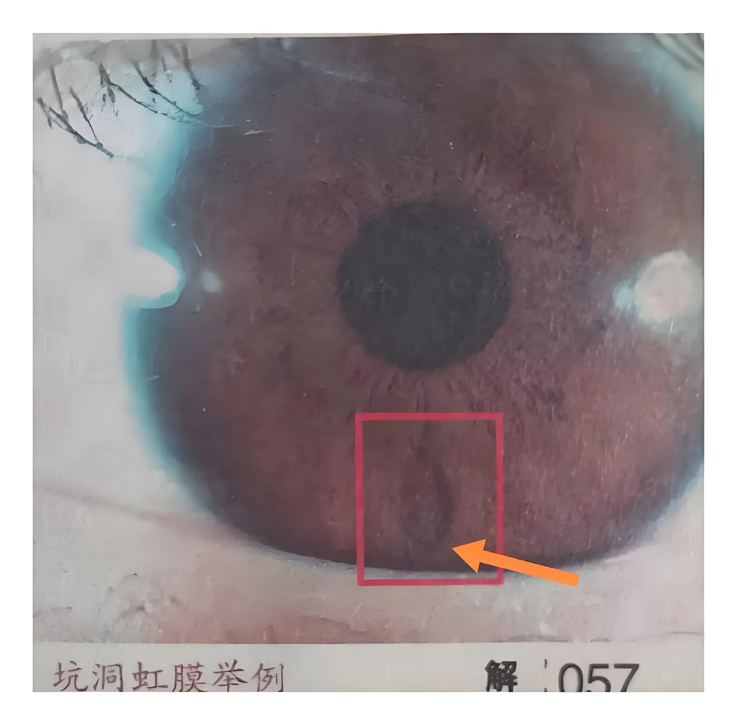 Iridoscope pour naturopathe: quel appareil choisir et comment l’intégrer à votre pratique en France — Iridology Between Pit iris (3).jpg