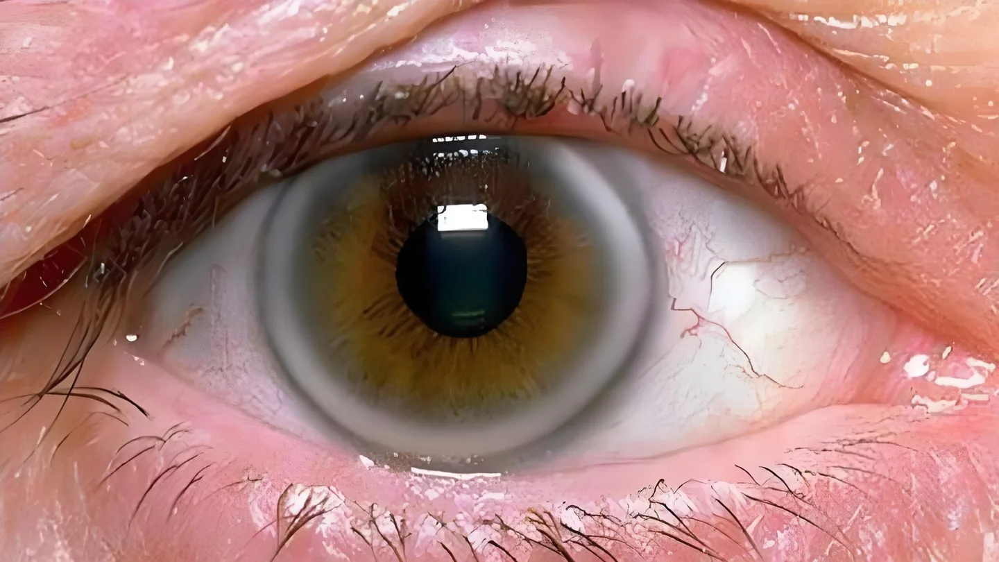 Iridoscope pour naturopathe: quel appareil choisir et comment l’intégrer à votre pratique en France — Iridology Iris sodium ring (3).jpg