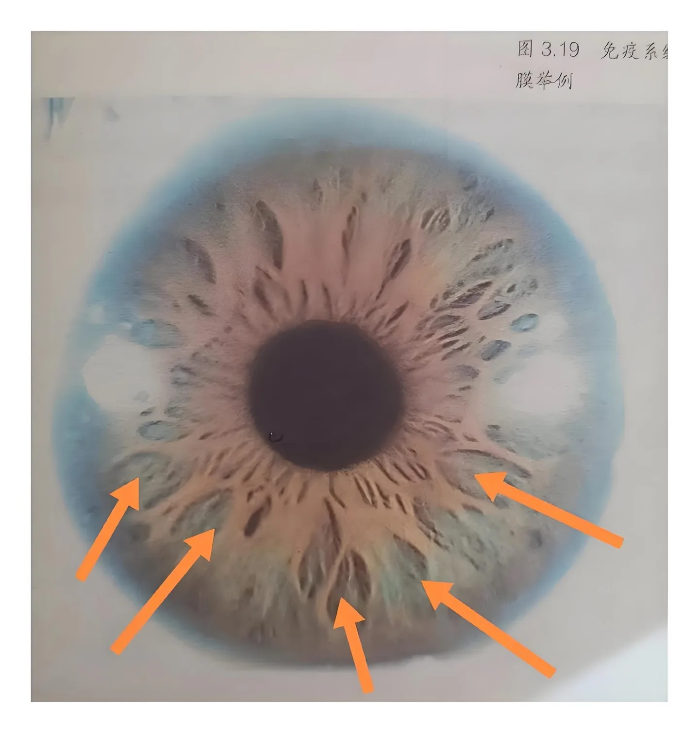 Iridoscope pour naturopathe: quel appareil choisir et comment l’intégrer à votre pratique en France — Iridology Between Pit iris (2).jpg