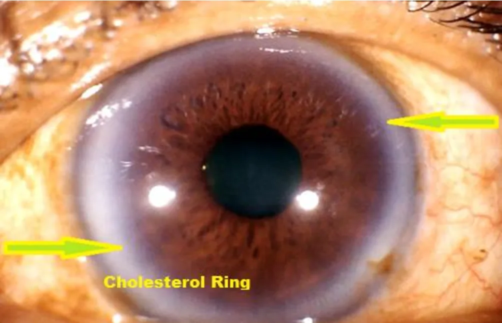 Iridoscope pour naturopathe: quel appareil choisir et comment l’intégrer à votre pratique en France — Iridology Iris sodium ring (1).png